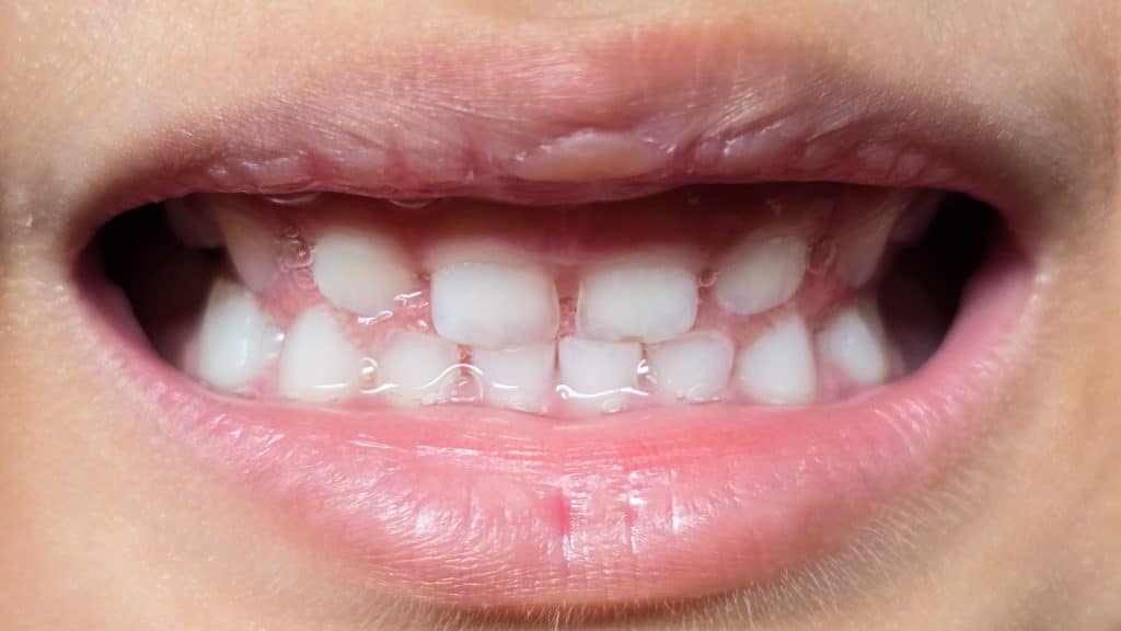Orthodontiste pour enfant à Calais