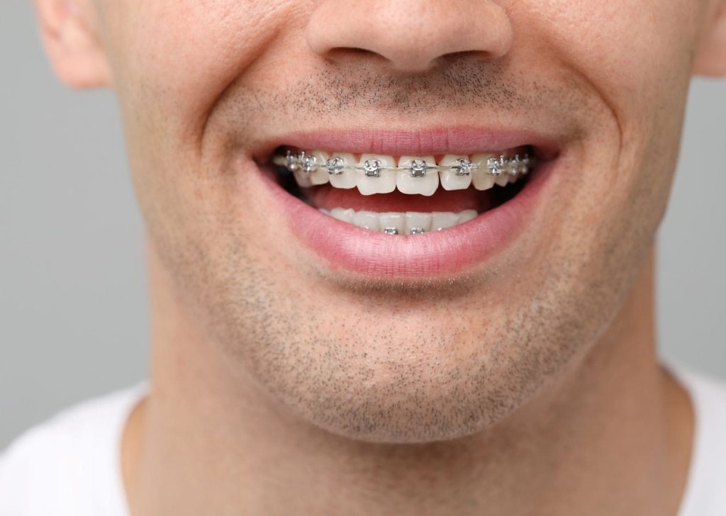 un appareil multi-attaches (bagues)