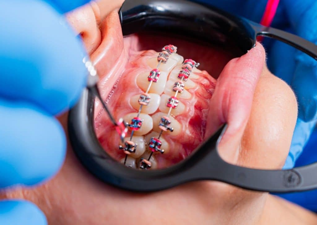 Un des piliers pour réussir son traitement d’orthodontie : bien porter son appareil
