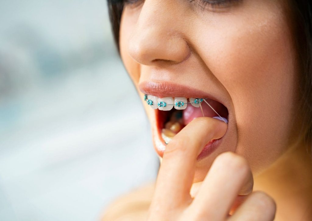 Que faire si l'on n'a plus d’élastiques ?