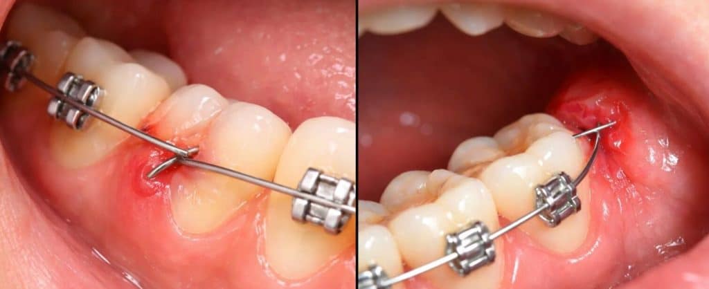 Que faire si un fil (arc orthodontique) me pique ?