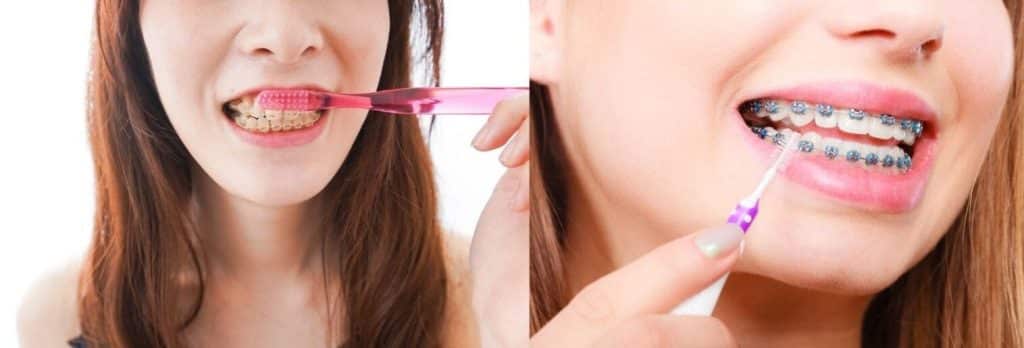 Pourquoi le brossage avec un appareil dentaire est VITAL