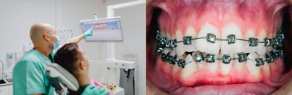 Pourquoi consulter chez un orthodontiste : consultation vs traitement orthodontique
