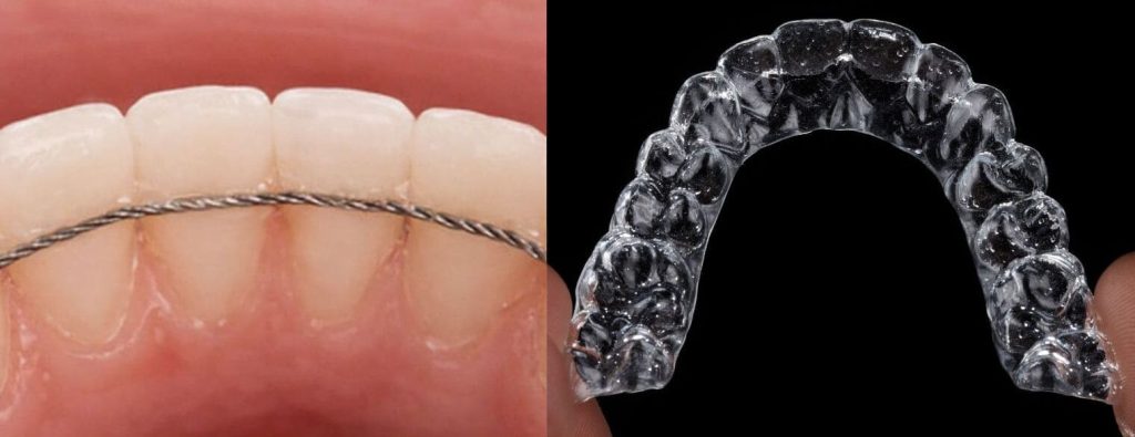 Dents qui bougent après orthodontie : la contention