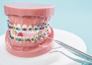 Durée du traitement orthodontique : combien de temps faut-il vraiment ?