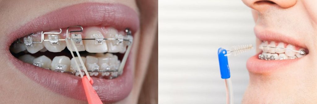 Coopération patient traitement orthodontique élastiques