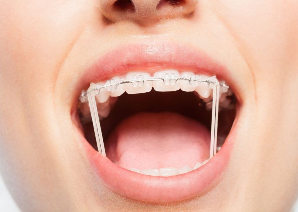 Comment bien porter les élastiques orthodontiques au quotidien