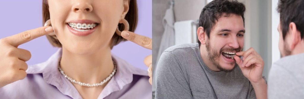 solutions orthodontie adulte discrètes